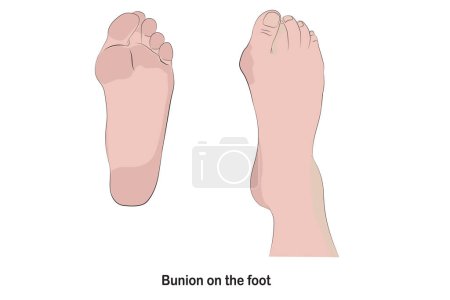 Ilustración de El juanete en el pie, hace que la base del dedo del pie sea empujada fuera de su posición normal. - Imagen libre de derechos