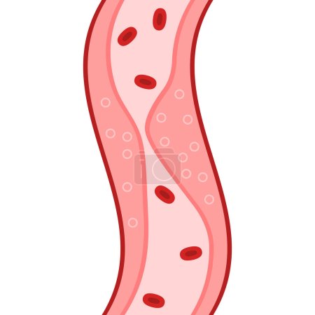 Illustration for Clogged Artery with platelets and cholesterol plaque. Cholesterol: Types, Importance, Prevention and Treatment. Disease Control. Cholesterol levels test. Blood cells with plaque buildup of cholesterol - Royalty Free Image
