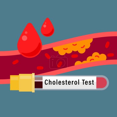 Ilustración de Análisis de colesterol en sangre. Muestra de sangre del paciente para el análisis de la prueba de colesterol en laboratorio. Ilustración vectorial - Imagen libre de derechos