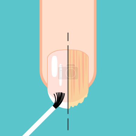 Fungal nail. Nail before and after fungal disease. Fungal and normal nail vector illustration. Nail diseases. Onychomycosis, fungal infection causes, treatment icon