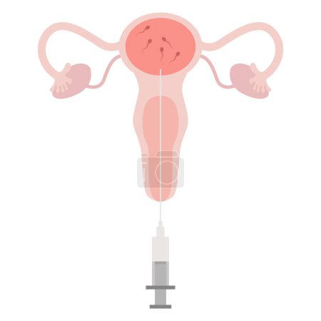 Tratamiento de la IU, inseminación intrauterina, servicio de esperma donante. El cepillado embarazada Ilustración con óvulos, espermatozoides bueno para la clínica médica cartel. Inseminación intrauterina IUI
