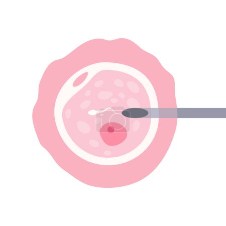 Téléchargez les illustrations : Injection intracytoplasmique de sperme (ICSI). Injection intracytoplasmique de sperme, ICSI, dans le cadre du processus de FIV - en licence libre de droit