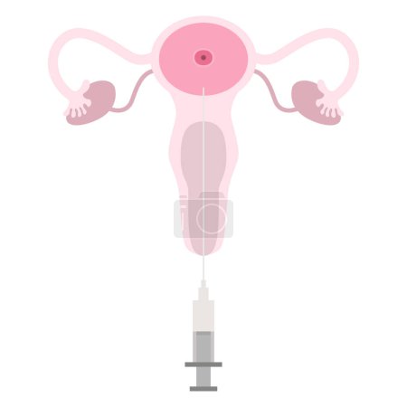 Illustration for Artificial insemination. In vitro fertilization IVF Artificial insemination and pregnancy ICSI technology. ET Embryo Transfer vector illustration. Reproduction, insemination or ivf - Royalty Free Image