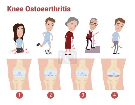 Téléchargez les illustrations : Infographie sur l'arthrose du genou pour expliquer la douleur, les douleurs au genou, les douleurs articulaires qui surviennent chez les adultes et les personnes âgées - en licence libre de droit