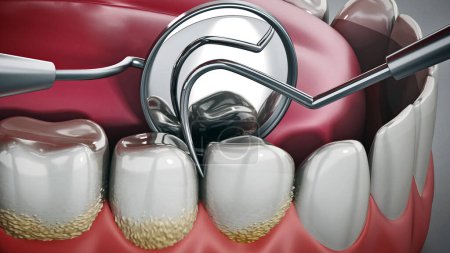 Foto de Ilustración 3D que muestra las herramientas del dentista y la placa dental en el modelo. Ilustración 3D
. - Imagen libre de derechos