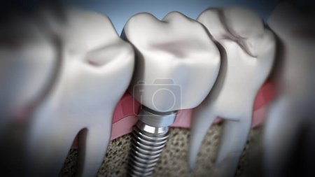 Téléchargez les photos : Reproduction 3D de l'implant dentaire montrant la gomme à mâchoires et les couches osseuses. Illustration 3D. - en image libre de droit