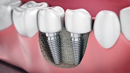 Téléchargez les photos : 3D illustration of two dental implants on the lower jaw. - en image libre de droit