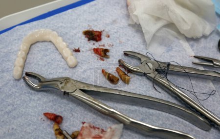 Dental surgery in progress featuring extracted teeth, fragments laid out next to various dental surgical tools including forceps and sutures on a sterile tray. Dentistry, prosthetics, implantation