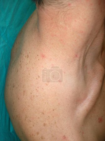 Photo for Spider telangiectasias, commonly referred to as vascular spiders, represent a cutaneous manifestation frequently observed in patients with liver cirrhosis. - Royalty Free Image