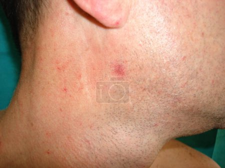 Photo for Spider telangiectasias, commonly referred to as vascular spiders, represent a cutaneous manifestation frequently observed in patients with liver cirrhosis. - Royalty Free Image