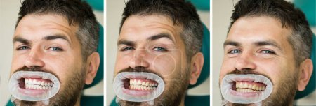 Téléchargez les photos : Homme isolé sur dents blanches : avant et après concept. Concept de stomatologie - gros plan du dentiste féminin avec les dents du patient masculin. Dents blanches ou jaunes - en image libre de droit