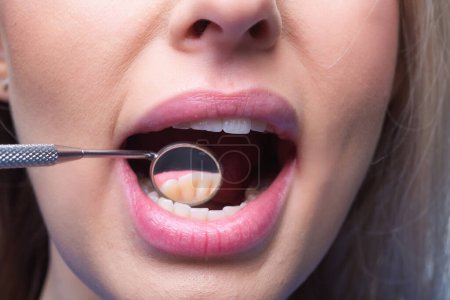 Téléchargez les photos : Les dents du dentiste se reflètent en gros plan. Examen des dents avec miroir dentaire. Hygiène dentaire. Clinique dentaire. Remplissage des dents. Dents examinées chez le dentiste. Dents de femme en bonne santé et miroir buccal dentiste - en image libre de droit