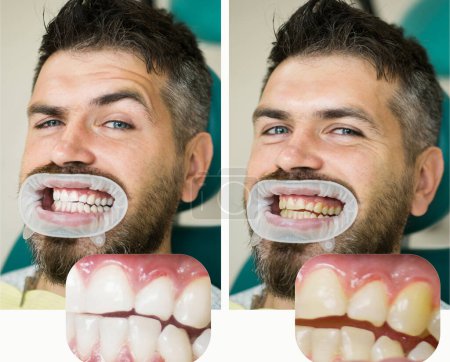 Téléchargez les photos : Blanchiment après et avant. Homme en fauteuil dentaire. Dentiste se préparant pour le blanchiment dentaire. Médecine de santé gens dentisterie médecin guérison. Résultat du blanchiment des dents - en image libre de droit