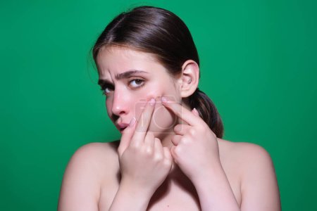 Photo for Sad Woman squeeze out pimples on cheek. Acne and pimple on skin. Dermatology, puberty woman. Pimples problem skin. Girl Squeeze out Pimple on skin cheek. Care from skin problem. Pimple face - Royalty Free Image