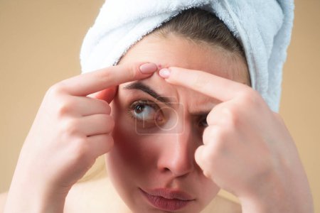 Photo for Close up Woman squeeze out pimples on forehead. Acne and pimple on skin. Dermatology, puberty woman. Pimples problem. Girl Squeeze out Pimple on face. Care from skin problem. Pimple face - Royalty Free Image