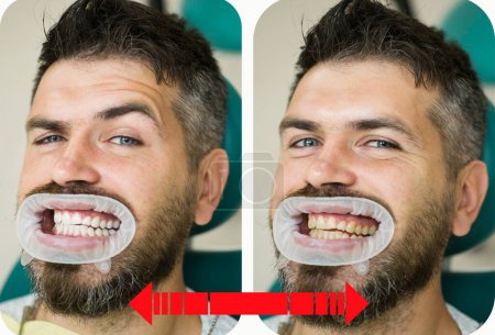 Téléchargez les photos : Dents jaunes vs blanches, avant ou après le blanchiment. Homme avec un fond isolé touchant la bouche avec une expression douloureuse en raison de maux de dents ou de maladies dentaires sur les dents. Détail en gros plan des dents d'homme - en image libre de droit