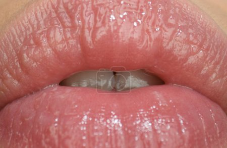 Filler-Spritzen, zarte Lippen. Sinnlicher weiblicher Mund