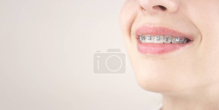 Photo for Portrait of a young girl with braces. Bite alignment. Working on a beautiful smile. Orthodontics, dentistry. - Royalty Free Image