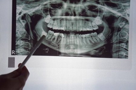 Foto de Imagen panorámica de la mandíbula del diente del paciente sobre un fondo azul claro. - Imagen libre de derechos