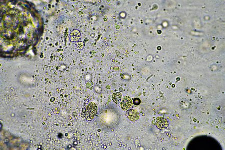 moco verde y tos con flema bajo el microscopio mirando las células gripales y los mocos de un humano enfermo en Australia