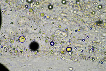 grüner Schleim und Husten unter dem Mikroskop beim Anblick von Grippezellen und kaltem Rotz eines in Australien erkrankten Menschen