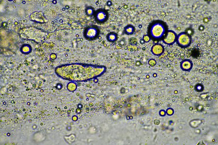 Coughing up mucus and phlegm from a chest infection from a virus and bacteria infection, looking at it under the microscope, with cells and microorganisms. Bacteria and skin cells in a human