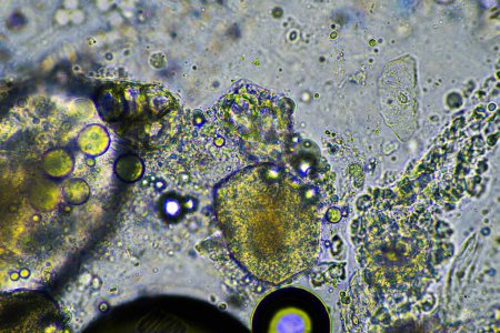 mucosités vertes et toux sous le microscope en regardant les cellules grippales et la morve froide d'un être humain malade en Australie
