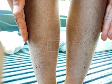 Photo for Baby leg, broken skin, dry, concept  Dermatitis, eczema, ringworm  cream lotion cosmetic - Royalty Free Image