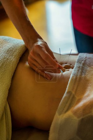 Téléchargez les photos : Jeune femme subissant un traitement d'acupuncture sur le ventre, gros plan - en image libre de droit