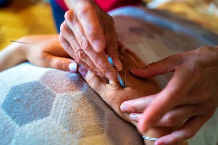 Téléchargez les photos : Macro détail de la main féminine à l'aide d'un tube d'insertion pour insérer une aiguille d'acupuncture Goshin dans la main d'une patiente. - en image libre de droit