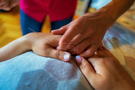 Téléchargez les photos : Traitement d'acupuncture sur la main du patient. Aiguilles sous la main - en image libre de droit