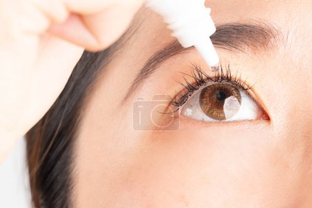 Woman applying artificial tear eye drop for relief dry eyes, irritated eye, conjunctivitis or optical symptoms. Close up.