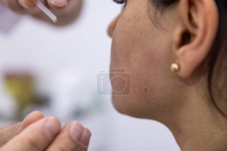 Photo for Dry needle treatment. A portrait of a small acupuncture needle sticking in a person's face next to the nose, to heal pain, relieve stress or another medical condition with alternative medicine. - Royalty Free Image