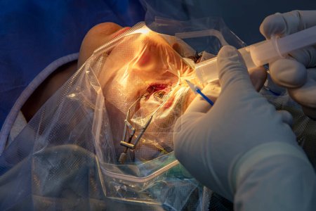 Photo for Laser vision correction. A patient and team of surgeons in the operating room during ophthalmic surgery. Patient under sterile lid.Ophthalmology surgery for eyes with laser correction for vision. - Royalty Free Image