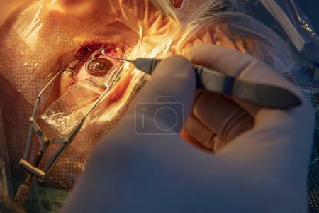Photo for Laser vision correction. A patient and team of surgeons in the operating room during ophthalmic surgery. Patient under sterile lid.Ophthalmology surgery for eyes with laser correction for vision. - Royalty Free Image