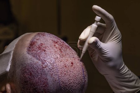Photo for Hair transplant dhi and fue system. Hair Transplant patient after the operation. Surgeons in the operating room carry out hair transplant surgery. - Royalty Free Image