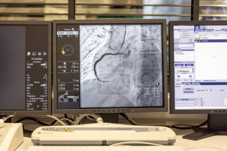 Angiogrammsequenz im Uhrzeigersinn mittels Röntgenstrahlen mit einem Kontrastmittel, das aus einer Röhre in die Arterien injiziert wird (links & Mitte), um die Gesundheit der Herzkranzgefäße zu zeigen.