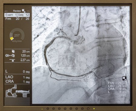 Téléchargez les photos : Séquence angiographique fonctionnant dans le sens des aiguilles d'une montre à l'aide de rayons X avec un agent de contraste injecté à partir d'un tube inséré dans les artères (gauche et centre), pour montrer la santé des artères coronaires. - en image libre de droit