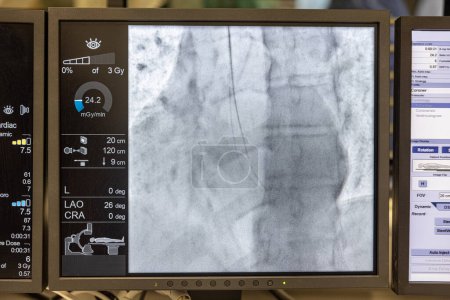 Angiogram sequence working clockwise using x-rays with a contrast agent injected from a tube inserted into the arteries (left & centre), to show the health of the coronary arteries.