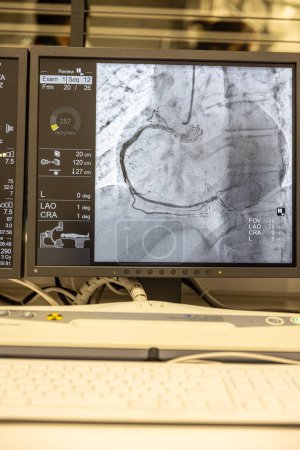 Téléchargez les photos : Séquence angiographique fonctionnant dans le sens des aiguilles d'une montre à l'aide de rayons X avec un agent de contraste injecté à partir d'un tube inséré dans les artères (gauche et centre), pour montrer la santé des artères coronaires. - en image libre de droit