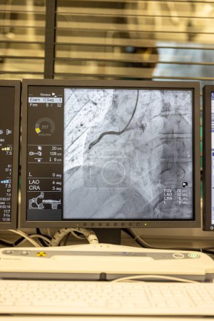 Angiogrammsequenz im Uhrzeigersinn mittels Röntgenstrahlen mit einem Kontrastmittel, das aus einer Röhre in die Arterien injiziert wird (links & Mitte), um die Gesundheit der Herzkranzgefäße zu zeigen.