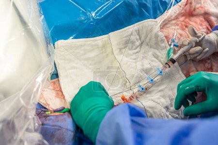 Photo for Heart stent placement process in operating room. Heart doctor inserting central venous catheter, Jugular venous catheterization. A central venous catheter is inserted into the jugular vena. - Royalty Free Image
