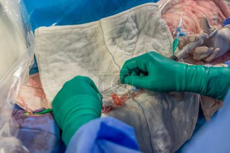 Photo for Heart stent placement process in operating room. Heart doctor inserting central venous catheter, Jugular venous catheterization. A central venous catheter is inserted into the jugular vena. - Royalty Free Image