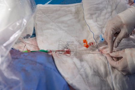Interventionelle Kardiologie. Chirurg bei der Operation. Stent und Katheter zur Implantation in Blutgefäße mit einem leeren und gefüllten Ballon. 