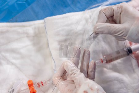 Interventional cardiology. Surgeon doctor at operation. Stent and catheter for implantation into blood vessels with an empty and filled balloon. 
