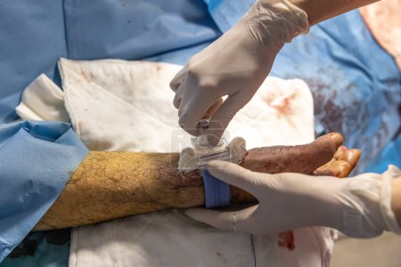 La enfermera cierra el acceso vascular del paciente después de la cirugía. Una enfermera aplica vendajes vasculares en el quirófano. Tratamiento médico para mantener sano al paciente. Concepto Atención sanitaria.