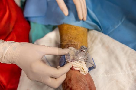 The nurse closes the vascular access of the patient after surgery. A nurse applies vascular bandages in the operating room. Medical treatment to keep the patient healthy. Concept Health care.