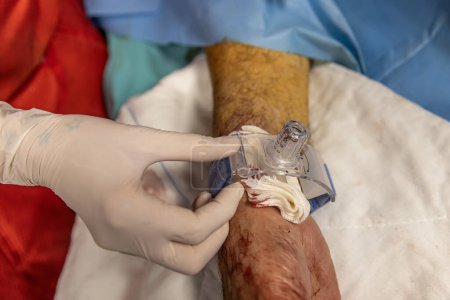 The nurse closes the vascular access of the patient after surgery. A nurse applies vascular bandages in the operating room. Medical treatment to keep the patient healthy. Concept Health care.