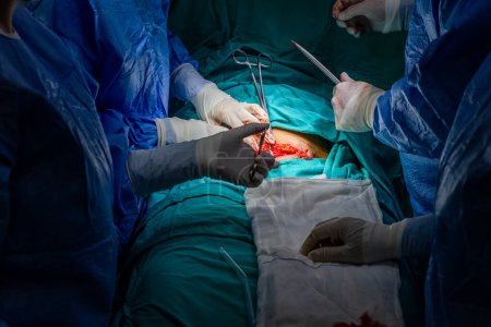 Cirujanos realizando cesárea en quirófano. Cirugía de parto con cesárea. Nueva vida, el bebé nace por cesárea en el quirófano (contenido maduro).