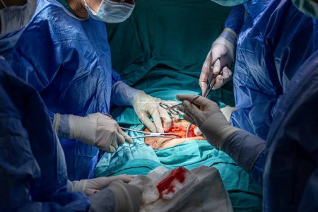Cirujanos realizando cesárea en quirófano. Cirugía de parto con cesárea. Nueva vida, el bebé nace por cesárea en el quirófano (contenido maduro).